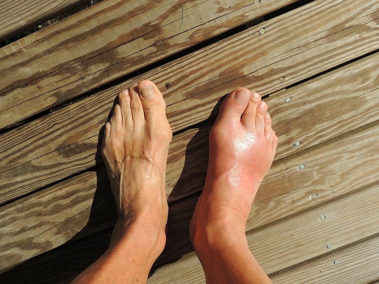 Gout On Feet